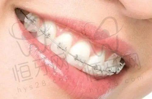 潍坊长河口腔：专注半口修复，避免咬合高度问题