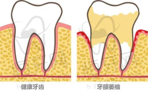 关于种植牙价格:揭阳市场均价区间梳理