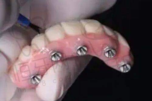 北京维乐口腔医院的亲民价目表