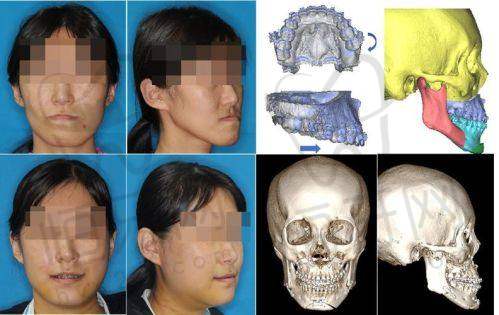 北京劲松口腔医院技术如何?3D导板种植+当天戴牙