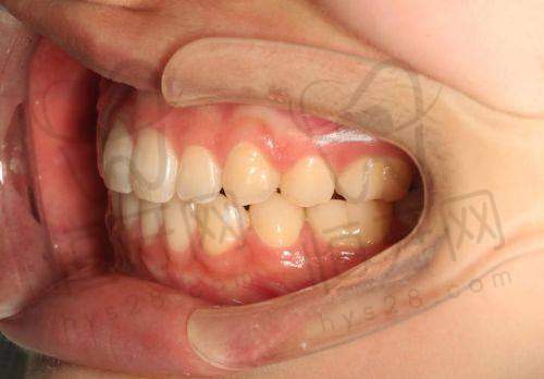 北京劲松口腔医院预约省钱秘籍