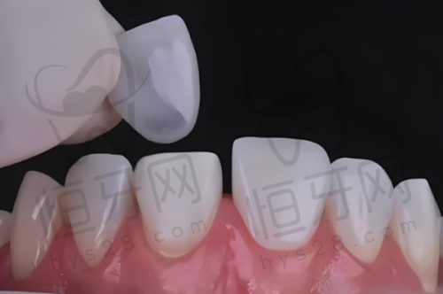 选择半口种植牙机构的建议