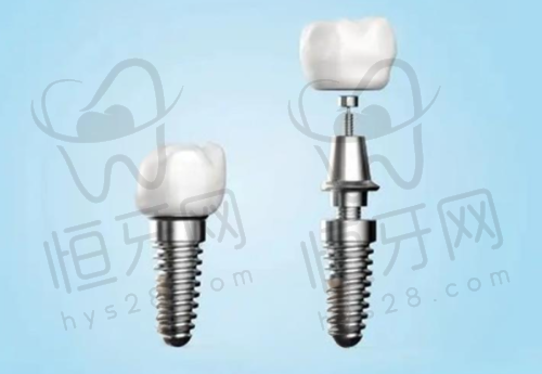 长沙种一颗牙费用参考